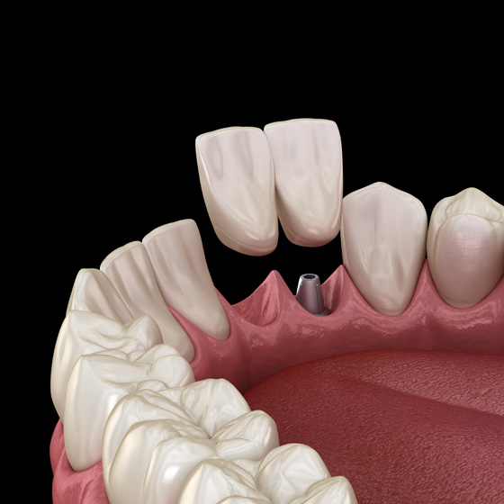 Cantilever Bridged Dental Implant