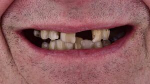 loose permanent tooth