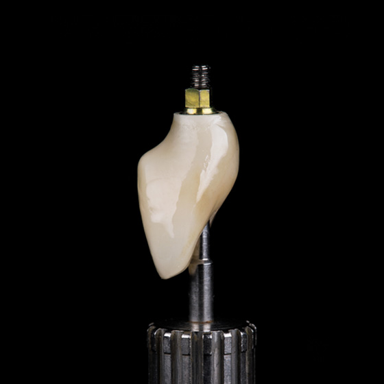 Single Dental Implants