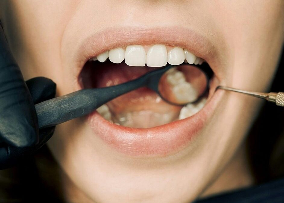 Hole in Your Gums? The Signs and Symptoms You Shouldn’t Ignore