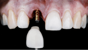 front teeth dental implants