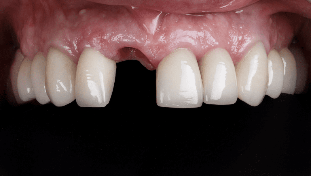 Can Dental Implants Replace Missing Front Teeth?