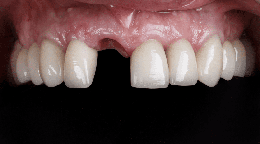 front teeth dental implants