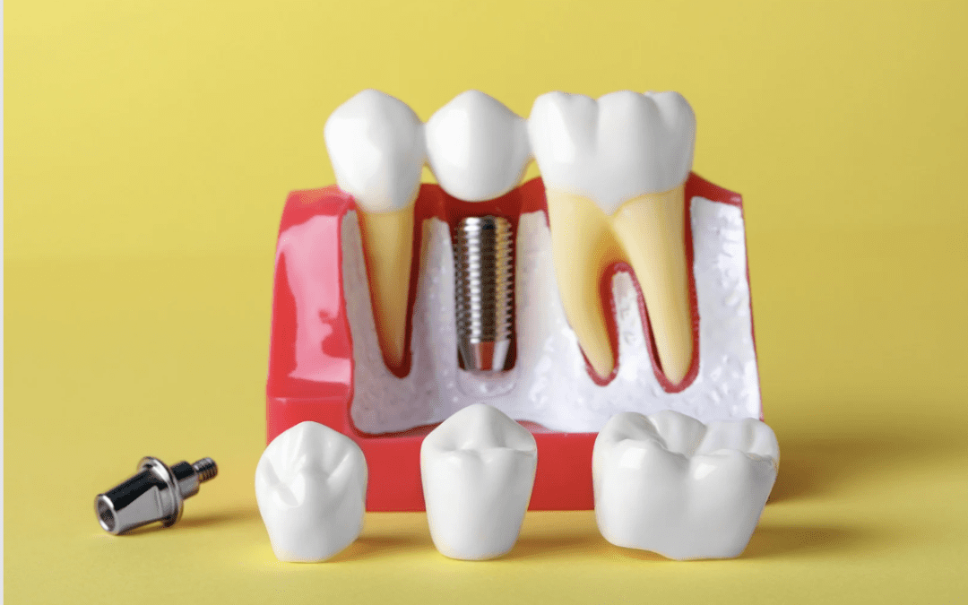 Dental Implant vs Crown: Which Is Right For You?